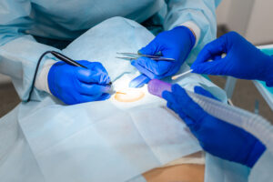 The surgeon does surgery to remove the mole on the patient's back. The process of burning moles in a private clinic to remove moles.